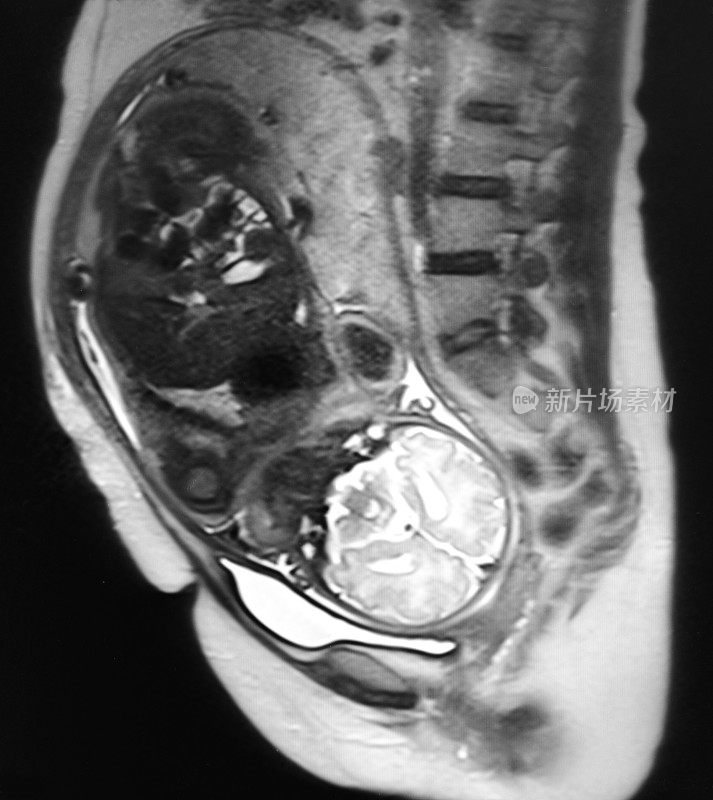 胎儿和孕妇MRI T2体重图像